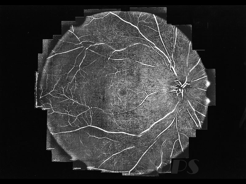 第5部門 部門賞「放射状乳頭周囲毛細血管のOCTAngiography（パノラマ画像）」