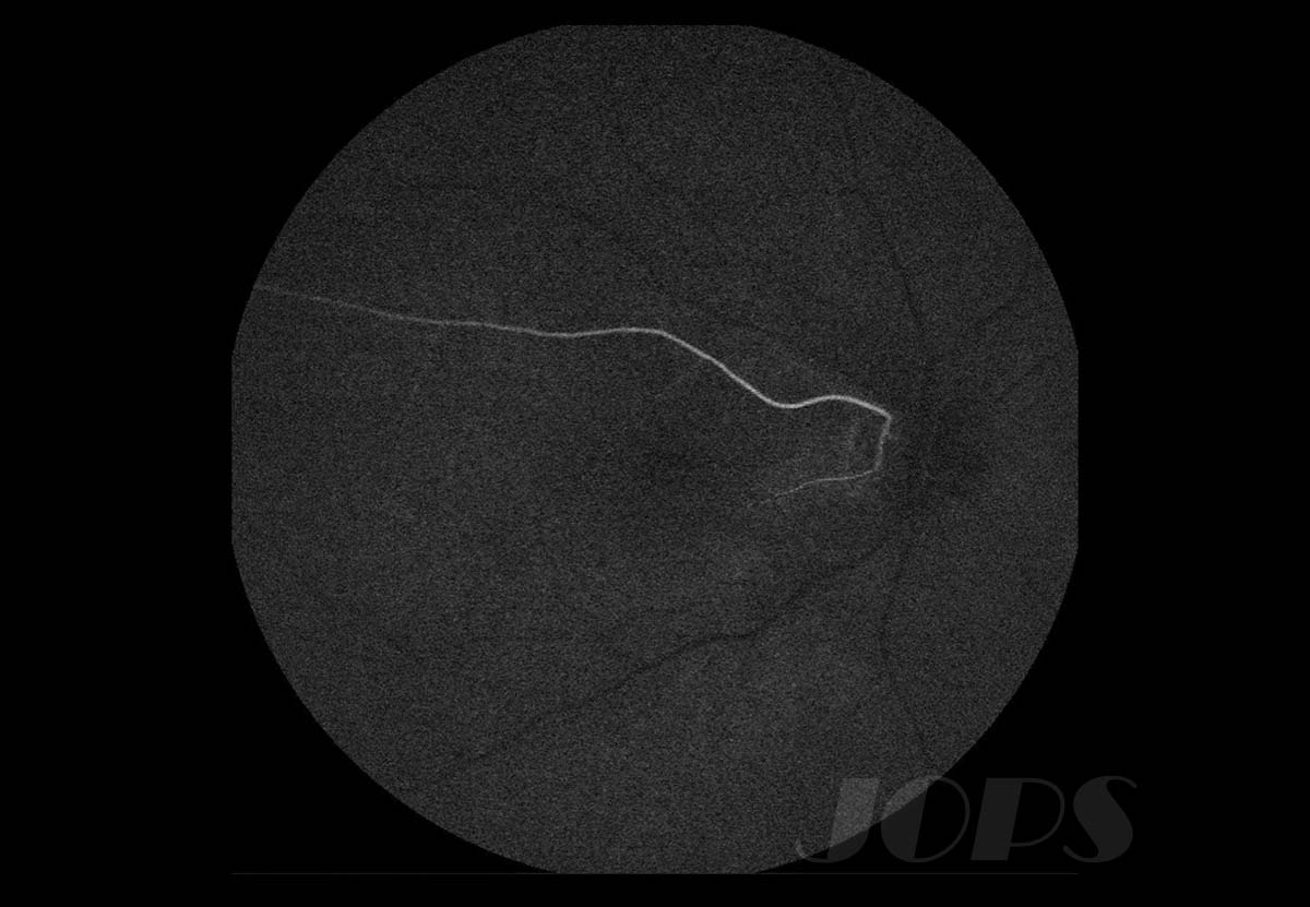 第2部門「cilioretinal artery」