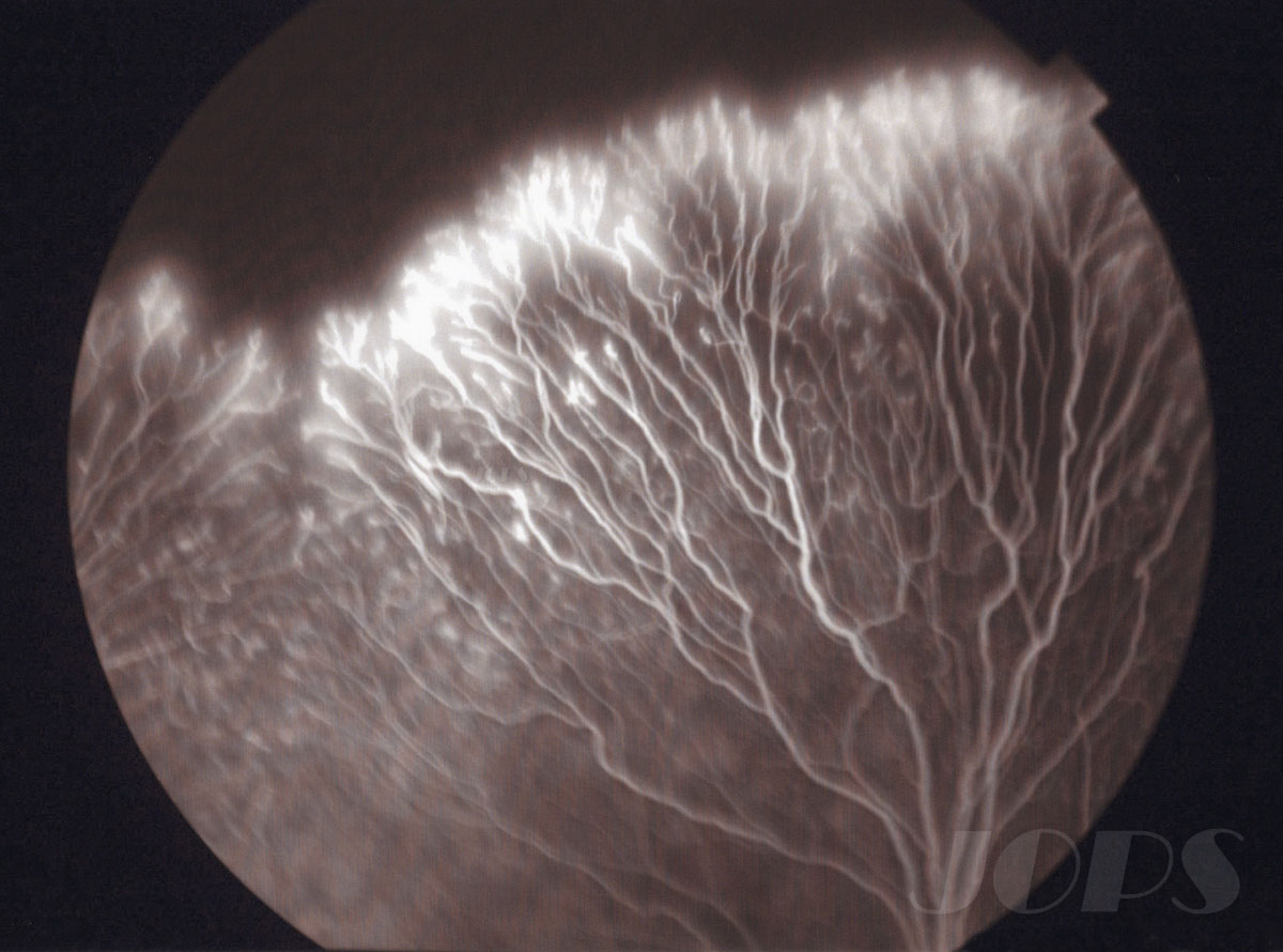 JOPS賞「家族性滲出性硝子体網膜症」