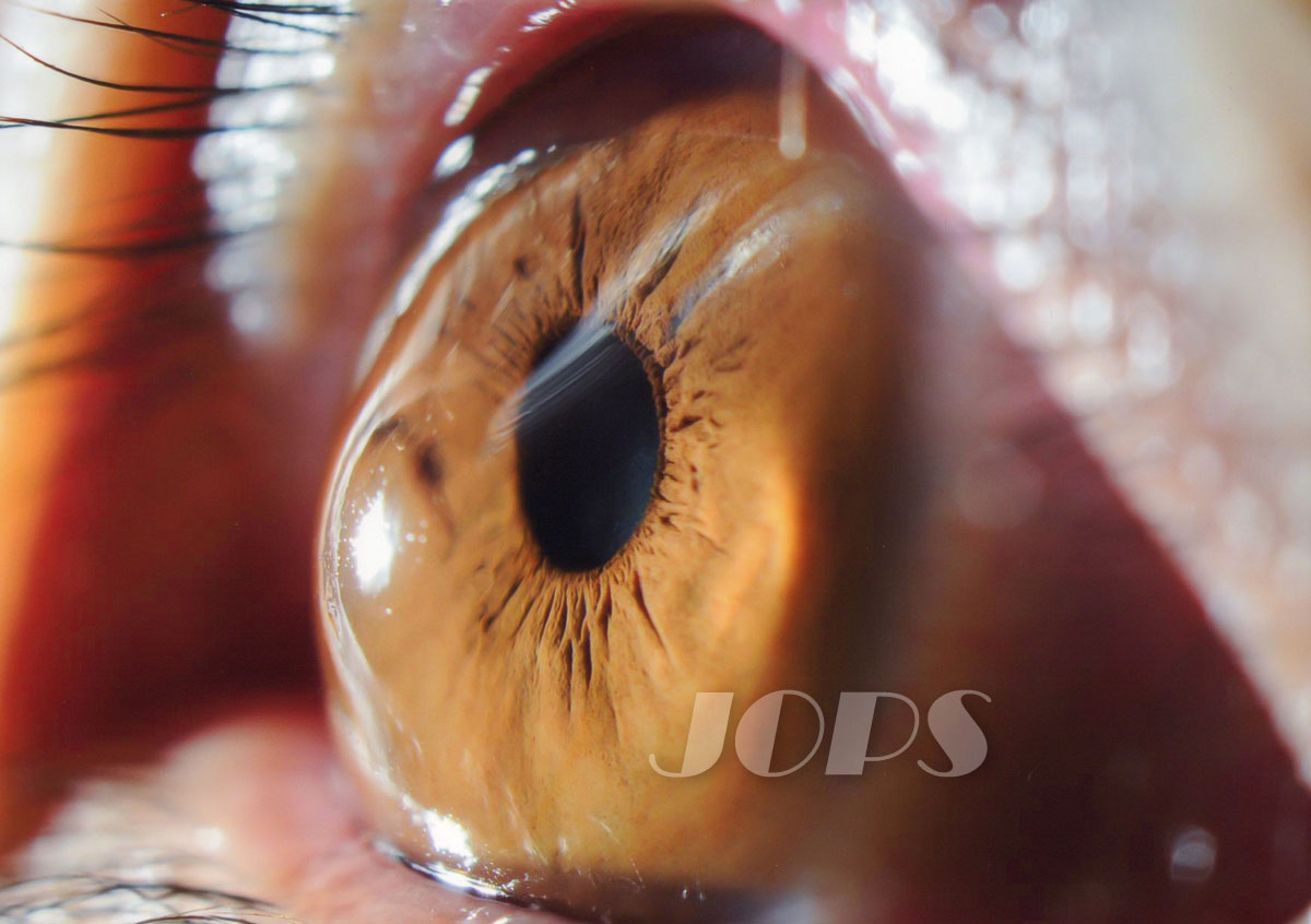 第3部門「円錐角膜」