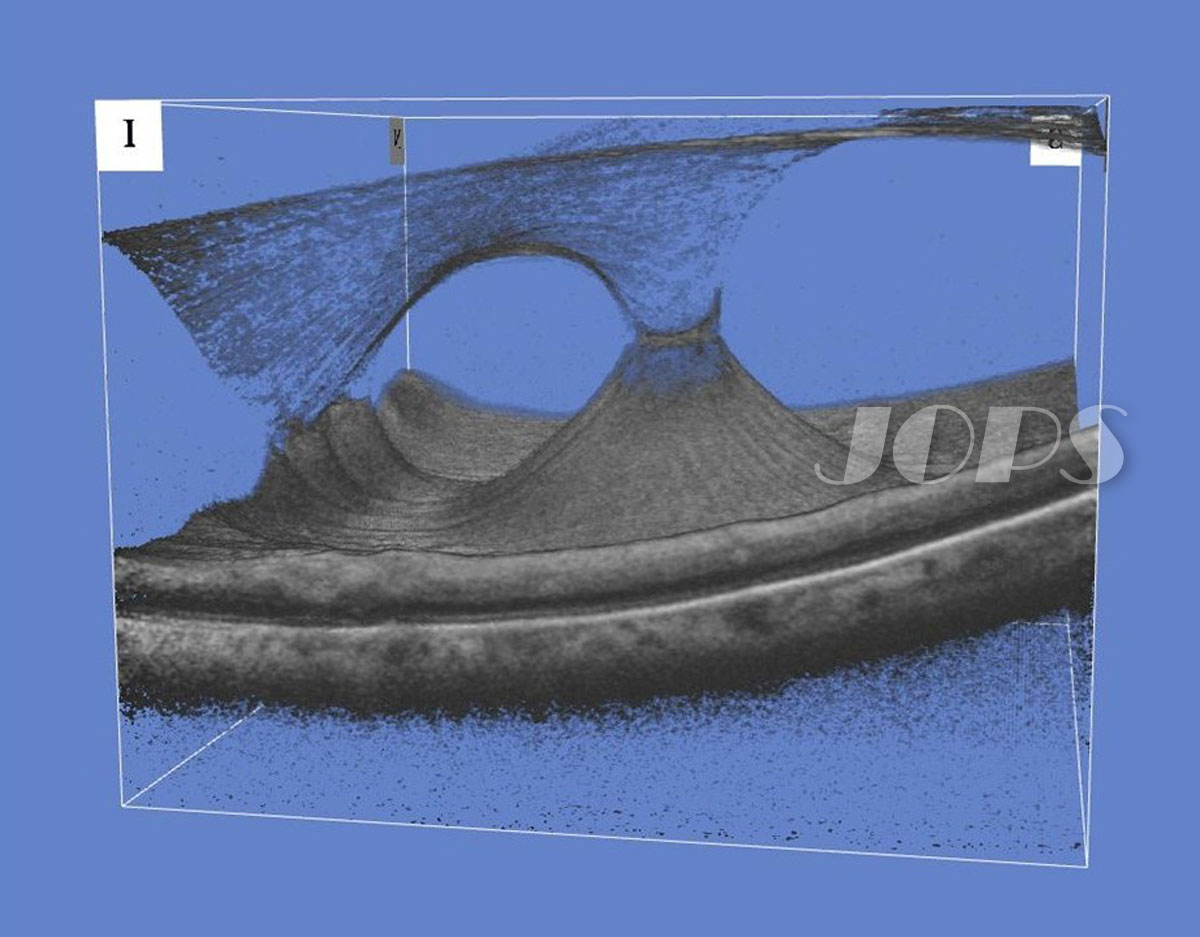 第5部門「黄斑硝子体牽引症候群」