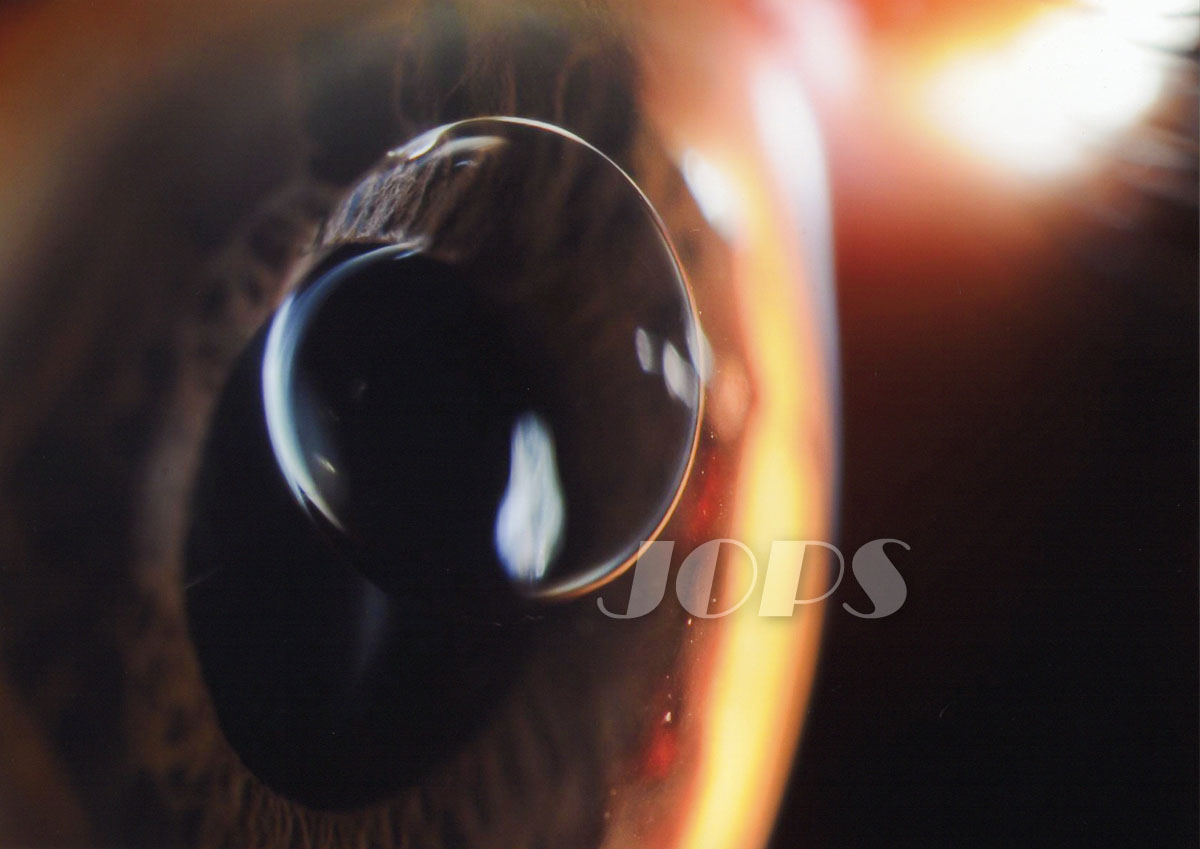 入門者部門「ガスの前房内迷入」